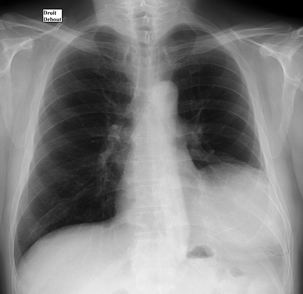 Radiografía torácica de 2006, que muestra una masa en el hemitórax izquierdo.