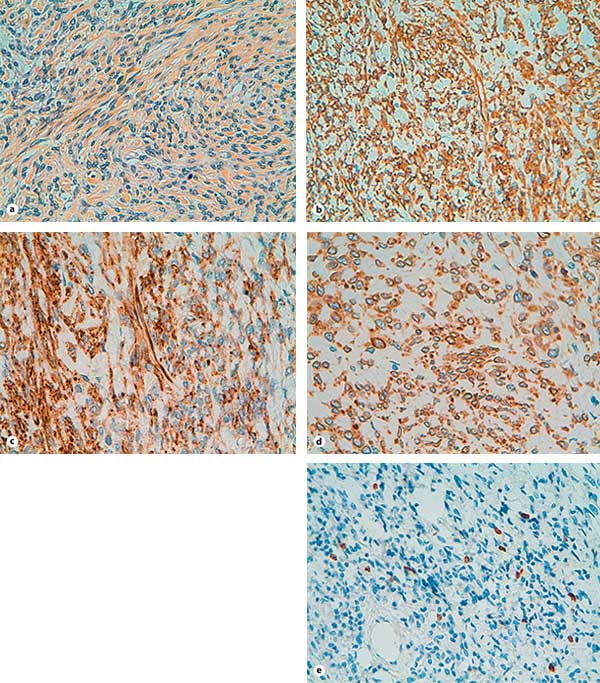 Examen microscópico del tumor.