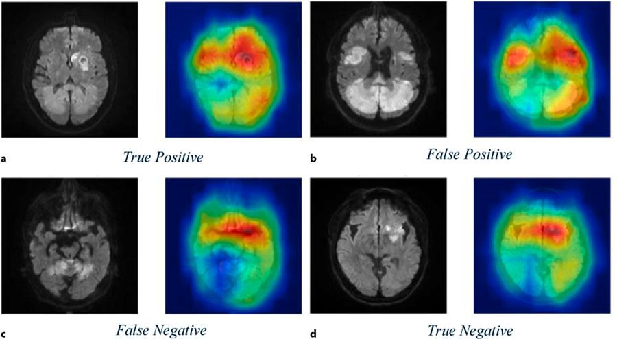The image shows four pairs of brain scans: MRI on the left and PET on the right. The pairs are labeled (a) True Positive, (b) False Positive, (c) False Negative, and (d) True Negative.
