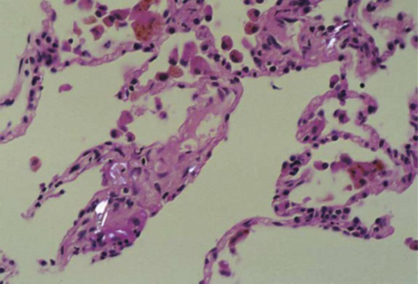Tejido alveolar