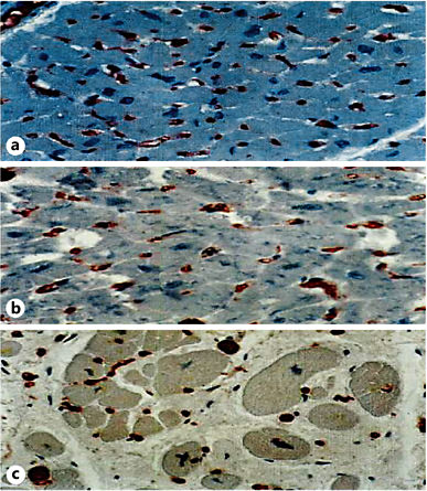 a Myocardial biopsy of control patient. Size of myocytes estimated between vessels (red). ×200. b Myocardium of hypertensive patient: increased myocyte cross-sectional area; reduced number capillaries per unit area; increased myocardial interstitial tissue. ×200. c Myocardium of CKD patient: myocardial cross section markedly increased. Further reduction in myocardial capillary density. Reproduced with permission from [37].