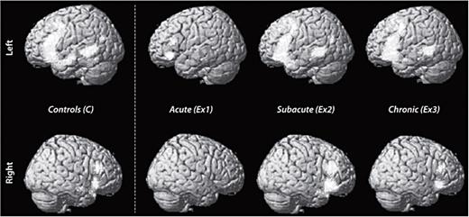 Temporofrontal language network activation measured in a task-based language paradigm in healthy controls and patients with aphasia after stroke in acute, subacute and chronic phases after stroke. Group analyses of 14 controls and 14 patients; marked areas are voxels significant at p < 0.05 corrected for multiple comparisons. Results are surface-rendered onto a canonical brain with the left side in the upper row and the right side in the lower row. From Saur et al. [29], with permission.