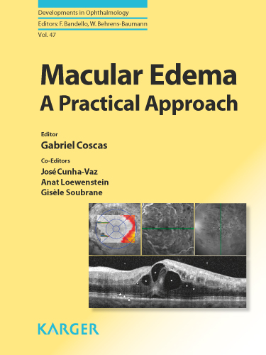 Book cover for Macular Edema: A Practical Approach