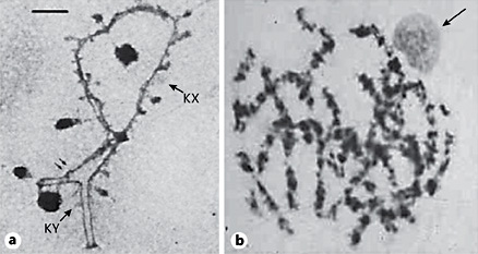 Human X-Y pairing structures before (a) and at meiosis (b) according to the microscopic analysis of Solari [29] on meiotic chromosome spreads with the electron microscope (a) and light microscope (b). In the early pachytene phase (a), the X and Y chromosome axes can pair beyond their homologous sequence region called PAR1 and the Y centromere including at least part of the Y long arm. Scale bar, 1 µm. During the late pachytene phase (b), X and Y forms a compact chromatin structure, also called the X-Y body or, more commonly, “sex vesicle.” However, note that this last term is wrong because no membranous vesicle is formed around the X-Y body in the spermatocyte nucleus.