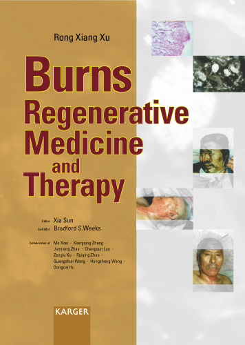 Book cover for Burns Regenerative Medicine and Therapy