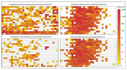 Fig. 6. Cellular distributions for prophylactic and IDC samples before and after debris removal. The effect of debris filtering was investigated by plotting the cellular density of each image taken of a touch prep slide. A typical prophylactic case would be expected to show low cellularity; however, initial outlines indicate a falsely high cellular density along the edges of the slide (top left). After debris filtering had been performed, debris outlines along the edge of the slide were properly removed, resulting in a 25× reduction in overall cellularity (bottom left). A typical IDC case showed highly dense clusters of cells in the middle of the slide (top right). After debris filtering, the cellular distribution on the slide remained unchanged while the overall cellularity dropped by only 2× (bottom right).