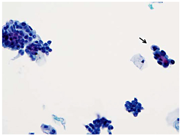 The Paris System for Reporting Urinary Cytology: The Quest to Develop a ...