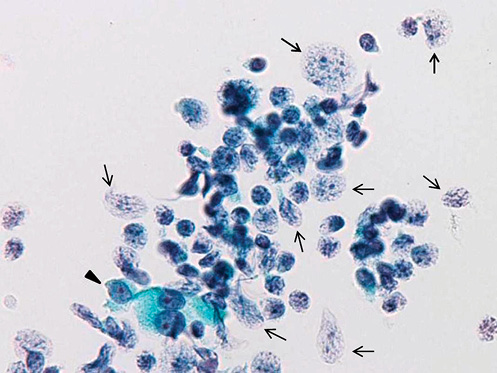 Fig. 1. Mucosa-associated lymphoid tissue lymphoma. The nuclei of lymphoma cells (arrows) are swollen and naked. The chromatin pattern is less punctate, and the nuclear margin is thinner. The chromatin is smashed, and nuclear margin is discontinuous. Follicular cells (arrowhead) have distinct cytoplasm, and the nuclei are not degenerative (LBC). Papanicolaou stain. ×400.