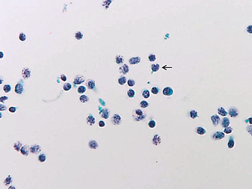 Fig. 3. Mucosa-associated lymphoid tissue lymphoma. Cleaved nuclei (arrow) with a deep cleft in the nuclear membrane are shown (LBC). Papanicolaou stain. ×400.