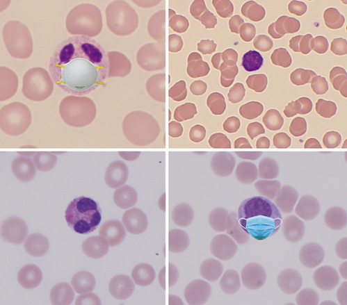 Fig. 1. Multiple high-power views of the peripheral smear attendees.