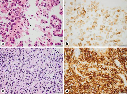 Fig. 1. An adenocarcinoma with concordant PD-L1 expression (both ≥50%) between paired EBUS cytology (a, b) and bronchial biopsy (c, d). Hematoxylin-eosin (a, c) and PD-L1 clone 22C3 (b, d). Scale bar, 20 μm. PD-L1, programmed death-ligand 1; EBUS, endobronchial ultrasound.