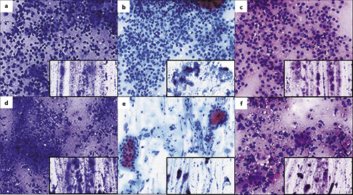  Slides in group 3 were digitalized using Pannoramic 250 Flash III scanner. a–c Show Giemsa-, Pap-, and hematoxylin eosin-stained cytologic slides prepared from papillary thyroid carcinoma are from colonic adenocarcinoma (d–f).