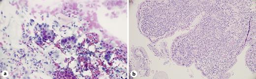 a A mixed inflammatory infiltrate consisting of neutrophilic granulocytes, a few plasma cells, and scattered lymphocytes can be seen in the background of a Pap smear (Papanicolaou stain, original magnification, ×400). b There is a superficial mixed inflammation consisting mainly of plasma cells and neutrophilic granulocytes in benign endocervical mucosa showing reactive changes. Inflammatory background in Pap smears correlated with significant mixed inflammation in histology (haematoxylin-eosin, original magnification, ×200).