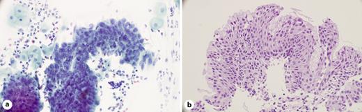 a Mildly enlarged endocervical cell nuclei with finely granular chromatin in a crowded fragment (Papanicolaou stain, original magnification, ×400). b An example of immature squamous metaplasia with a layer of preserved cytologically benign endocervical cells on top of the squamous metaplastic cells. Endocervical glandular cells with finely granular chromatin pattern were most frequently encountered in association with immature squamous metaplasia in histology (haematoxylin-eosin, original magnification, ×400).