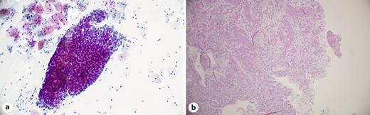 a There is a thick epithelial fragment with palisading borders in a background of scattered inflammatory cells consisting mainly of neutrophilic granulocytes (Papanicolaou stain, original magnification, ×400). b Figure represents granulation tissue with oedemic stroma, reactive vascular and stromal cell proliferation, and neutrophil-dominant background inflammation. Palisading cell borders, as well as overall scant cellularity in Pap smears were associated with granulation tissue formation in histology (haematoxylin-eosin, original magnification, ×100).