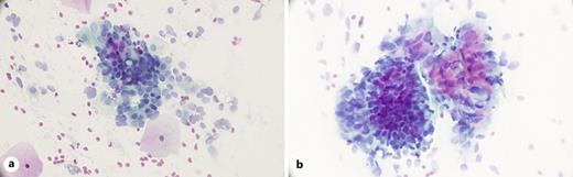 a, b Examples of atypical endocervical cell fragments with degenerative changes, nuclear crowding, and variation of size and shape of the nuclei (Papanicolaou stain, original magnification, ×400). Degeneration and nuclear crowding were the best cytological features distinguishing the AEC, NOS Pap smears harbouring a malignant endocervical glandular lesion from those with histologically proven benign changes only.