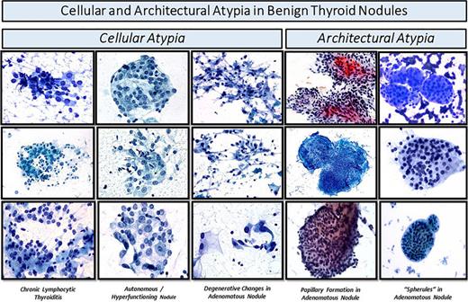 Examples of cellular and architectural atypia in FNAC of Bethesda III category diagnoses ultimately confirmed benign by histopathology.