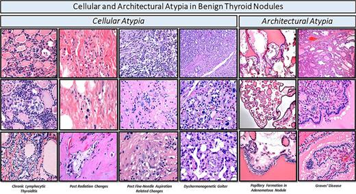 Histologic features associated with cellular and architectural atypia in FNAC.