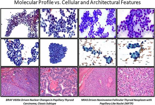 Cellular/nuclear and architectural features in a BRAF V600E-driven, classic PTC compared to NRAS-mutated NIFTPs. Note the prominent nuclear atypia and clear-cut papillary architecture in the fine-needle aspirate of a classic PTC compared to the subtle nuclear and architectural atypia with microfollicles of an NIFTP.