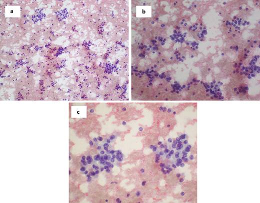 Smears revealing clusters and single cells with abundant granular cytoplasm and monomorphic nuclei with granular chromatin and indistinct nucleoli, Pap stain. a ×20 magnification. b ×40 magnification. c ×60 magnification.