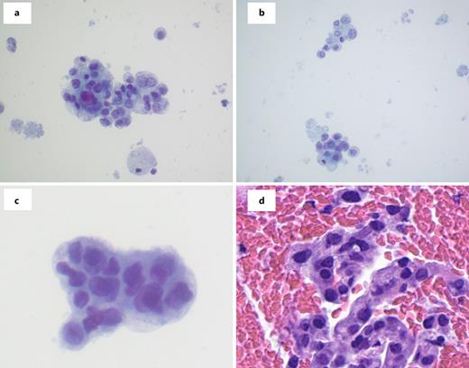 a–c Liquid-based preparation revealing clusters of epithelial cells with high-grade atypia (Pap stain. ×60 magnification). d H&E section revealing detached atypical epithelial cells.