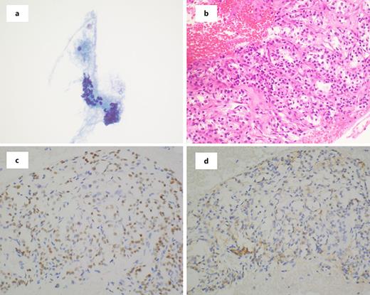 a Liquid-based preparation revealing clusters of tumor cells (Pap stain. ×60 magnification). b H&E section revealing clear cell renal cell carcinoma. Immunostains for PAX-8 (c) and CA-IX (d).