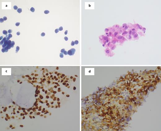 a Liquid-based preparation revealing clusters and single tumor cells (Pap stain. ×60 magnification). b H&E section revealing melanoma. Immunostains for SOX-10 (c) and HMB45 (d).