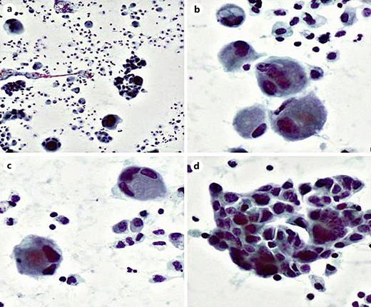 Cytomorphology of metastatic dedifferentiated liposarcoma on the peritoneal fluid. The cells were seen to form clusters mimicking carcinoma (a) and showed epithelioid morphology with cytoplasmic vacuolations (b), multinucleation (c), and pleomorphic cell clusters (d). Papanicolaou stain, ×20 (a, b), ×40 (c, d).