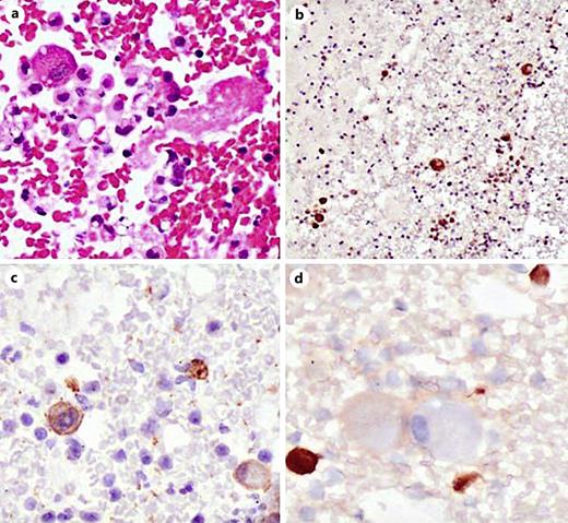 Cell block showing tumor cells admixed with mesothelial cells (a) which is highlighted by MDM2 (b) and SMA (c) immunoreactivity, while calretinin was negative (d). The cells which are immunopositive for calretinin are mesothelial cells.