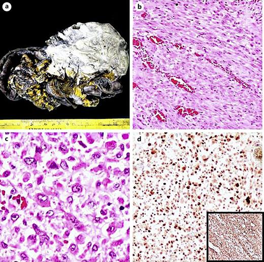 Gross specimen of dedifferentiated liposarcoma shows a large intraperitoneal mass measuring 18 × 17 cm with adhered intestinal loops (a) with histopathology showing low-grade areas with spindle cells arranged as fascicles (b). High-grade areas with tumor cells showing epitheliod to rhabdoid morphology (c). MDM2 IHC showed diffuse nuclear positivity with the inset showing p16 positivity (d).