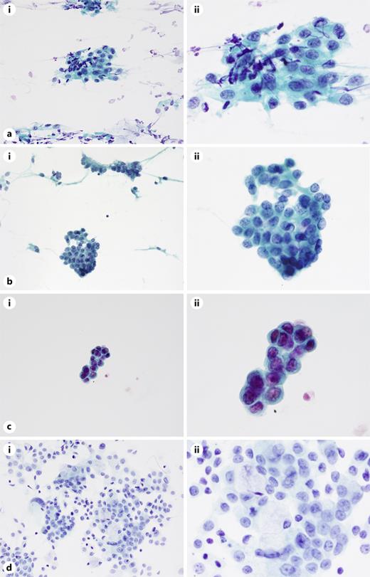 Cases with low tutorial effects. a Case 38, granuloma in the benign category. In this case, the cells do not have a distinct nuclear size difference or chromatin hyperexpansion. The cytoplasm is somewhat thicker and more abundant, with additional squamous metaplasia; magnification: ×100 (ai) and ×400 (aii). b Case 9, interstitial pneumonia in the atypical category. The nuclei of the cells are not different in size, and the chromatin is uniform, but dense proliferating cells are observed. The cells are presumed to be bronchial epithelial cells, although no obvious lineage brushes can be observed; magnification: ×100 (bi) and ×400 (bii). c Case 34, ADC in the suspicious for malignancy category. Cells with diverse chromatin are irregularly stacked. ADC is presumed, but size disparity and nuclear atypia are not obvious; magnification: ×100 (ci) and ×400 (cii). d Case 4, mucoepidermoid carcinoma in the malignant category. Cell clusters are observed in the cytoplasm, and mucus-containing, eccentric nucleus and mucus-free cells are adjacent to each other. The nuclear findings are similar. The case is presumed to be mucoepidermoid carcinoma; magnification: ×100 (di) and ×400 (dii).