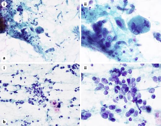 Difficult-to-diagnose cases by histological type. a Case 24, SQCC in the suspicious for malignancy category. The background of the specimen is necrotic. In this case, irregularly stacked cell clusters and large atypical cells are seen. Estimating the histological classification is difficult; magnification: ×100 (ai) and ×400 (aii). b Case 25, SCLC in the malignant category. In this case, the chromatin is fine and granular, and the naked nucleus-like cells lacking cytoplasm appear as loosely bound aggregates. SCLC is presumed; magnification: ×100 (bi) and ×400 (bii).