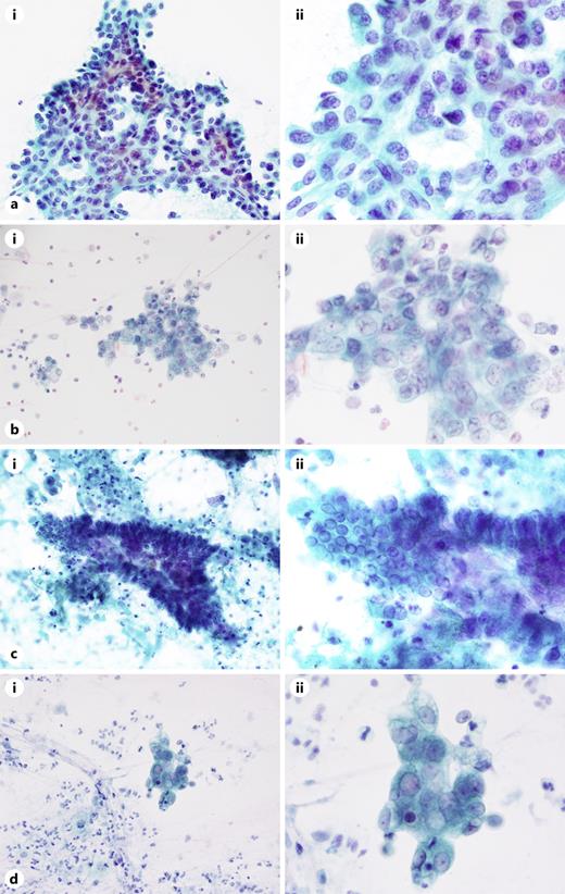 The cases with high tutorial effects. a Case 15, sclerosing pneumocytoma in the benign category. In this specimen, the vascular interstitium is in the center of the cell aggregates, and little variation in the size of the cells can be detected. In addition, the cell density has increased. No obvious nuclear atypia can be detected, and the cells appear to be a cluster of atypical cells similar to type II alveolar epithelium. Spindle cells are also seen in the specimen. We presume sclerosing alveolar epithelioma, which is a benign tumor; magnification: ×100 (ai) and ×400 (aii). b Case 3, rheumatoid lung in the atypical category. The background of this specimen is inflammatory. The cells are irregularly stacked, with markedly different sizes of nuclei and nuclear atypia. However, these cells are uniform with no chromatin hyperplasia, and normal lineage cylinder epithelial cells are present. Regenerative bronchial epithelial cells are presumed; magnification: ×100 (bi) and ×400 (bii). c Case 41, inflammation in the atypical category. Cell-dense aggregates are arranged in a fenestrated pattern with some stacking. Although the nuclei are enlarged, the individual cells do not show clear atypia, suggesting bronchial epithelial cells; magnification: ×100 (ci) and ×400 (cii). d Case 6, ADC in the suspicious for malignancy category. An inflammatory background can be observed. The cell aggregates show irregular stacking. The cytoplasm of these cells is lacy, the nuclei are irregularly sized, and small nucleoli are present in the nuclei. Nuclear atypia is also present, and the chromatin is fused. The cells are suspected to be ADC but are also suspicious for malignancy due to the marked degeneration and vacuolation of the cytoplasm; magnification: ×100 (di) and ×400 (dii).