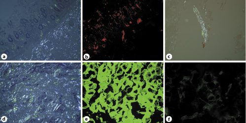 Fig. 2. a Colon biopsy positive for amyloid by Congo red stain. Small deposits of amyloid are seen in the lamina propria, focally in muscularis mucosae and vasculature. Congo red stain viewed under polarized light. Original magnification 100×. b Colon biopsy, the same field as in a. Amyloid deposits are more readily visible. Congo red stain viewed under fluorescence light using TRITC filter. Original magnification 100×. c Bone marrow biopsy specimen with periosseous soft tissue positive for amyloid while the actual marrow was negative (not shown). Congo red stain. Original magnification 200×. d Carpal tunnel biopsy specimen positive for amyloid by Congo red stain while amyloid deposits were inconspic-uous by H&E stain (not shown). Original magnification 200×. e, f Fat biopsy stained with anti-lambda light chain antibody (e) and anti-kappa light chain antibody (f) illustrating lambda light chain restriction. Immunofluorescence stains in frozen section. Original magnification 400×.