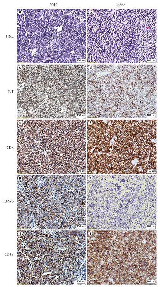 Fig. 2. Morphological and immunohistochemical comparison between diagnostic material from the mediastinal mass from the original thymoma diagnosis (2012) and from the later diagnosis of T-lymphoblastic lymphoma/leukemia (2020), depicted by the type of histological stain. H&amp;E stain of the 2020 biopsy showing predominantly medium-sized lymphoblastic-rich infiltrate, highlighted by positive TdT, CD3, and CD1a immunostaining (d, f, j). Notice the negative stain for CK5/6 in the T-lymphoblastic lymphoma/leukemia (h) discriminating it from the previous patient’s known thymoma (2012) (×20). Scale bars, 100 µm.