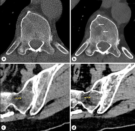 Axial slices through the thoracic spine (a, b) and the pelvis (c, d). EID-CT on the left (a, c) and PCD-CT on the right (b, d). Lytic lesions in the vertebral bodies on the PCD-CT image (white solid arrows; b) are more conspicuous than on the EID-CT image (a). In the pelvis, a focal lesion in the left sacrum (yellow dash arrow) is also more obvious on the PCD image (d).