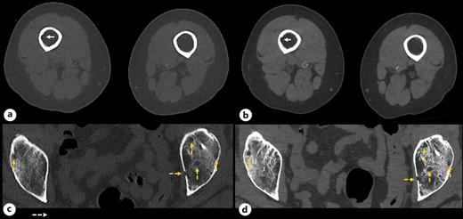 Axial slices through the mid femur (a, b) and the supra-acetabular iliac region of the pelvis (c, d). Endosteal scalloping of the inner table of the right distal femur (solid arrows) is seen on EID-CT (a) and PCD-CT (b) images. In the pelvis, where the low-dose levels greatly impact lesion visibility, small lytic lesions (yellow dashed arrows) are more conspicuous on the PCD-CT image (d) compared to the clinical standard EID-CT (c).