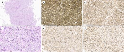 a, b High grade B-cell lymphoma (hematoxylin and eosin, original magnification, ×4, ×20) with neoplastic lymphoid infiltrates of large-sized B cells with a diffuse pattern. c Neoplastic cells stained for CD20 (CD20, original magnification, ×10). d Positive staining for MUM-1 (MUM-1, original magnification, ×10). e Neoplastic cells positive staining for Bcl-2 (Bcl-2, original magnification, ×10). f Positive staining for Bcl-6 (Bcl-6, original magnification, ×10). The slides were digitized with an Aperio AT2 scanner with 40× optics.
