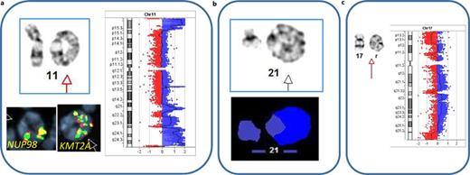 Partial karyotypes of three representative ring chromosomes. a r(11) from a patient with de novo AML. Metaphase FISH of isolated chromosomes 11 showed amplification of unrearranged KMT2A using break-apart probe at 11q23 chromosomal site and one copy of NUP98 at 11p15 site. The r(11), designated as r(11)(p15q23), was identified in a setting of monosomal karyotype including loss of chromosome 5, 7, and 17. Array CGH+SNP detected chromothripsis characterized by multiple losses and gains of chromosome 11 segments. b Metaphase FISH, using whole chromosome painting FISH probe, identified ring (21), der(21)r(21)(p12q22) showing HSR of the 21q22 chromosomal band. The ring was detected at the diagnosis of MDS in setting of a complex karyotype, including del(5q) and TP53 mutation. c Partial karyotype of r(17) from bone marrow cells of a patient with de novo AML, monosomal karyotype and chromoanasynthesis (detected by aCGH+SNP) of chromosome 17 from p13.3 to q25.3. After 3 months of therapy, follow-up genomic analysis showed a normal karyotype and lack of complex genomic changes including r(17).