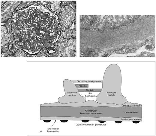 Fig. 3. a Pathological changes of advanced diabetic nephropathy include increased glomerular basement membrane thickness, mesangial matrix expansion, nodular glomerulosclerosis, glomerular hypertrophy, and arteriolopathy of afferent and efferent arterioles. b Electron microscopy showing increased basement membrane thickness. c The barrier to proteinuria. Schematic drawing of the visual glomerular epithelial cells (podocytes) lining the outer aspect of the glomerular basement membrane. Foot processes are connected by the slit diaphragm with nephrin, podocin, and other proteins. Proposed mechanisms of diabetic proteinuria include structural changes to the basement membrane, hemodynamic injury to podocytes, decreased number of podocytes, damaged slit diaphragm components, and reduced expression of nephrin.