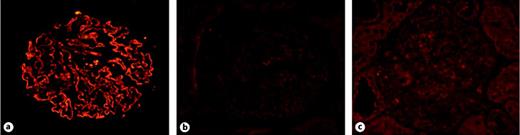 Fig. 1. The staining of PLA2R in the kidney. Renal PLA2R was positive by granular distribution along the glomerular capillary wall in MN patients (a), but negative in these slides added secondary antibody only (b) and in healthy control (c). (Original magnification ×400.)