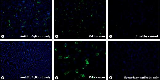 Fig. 2. Indirect IF for PLA2R-Ab detection. HEK 293 cells transfected with a PLA2R isoform 1 full length cDNA were incubated with a rabbit anti-PLA2R-Ab (a, ×200), or serum from an idiopathic MN patient (c, ×200 and d, ×400), or serum from a healthy control (e, ×400), or the secondary antibody only (f, ×400). HEK 293 cells transfected with a control cDNA without PLA2R were incubated with a rabbit anti-PLA2R-Ab (b, ×200).