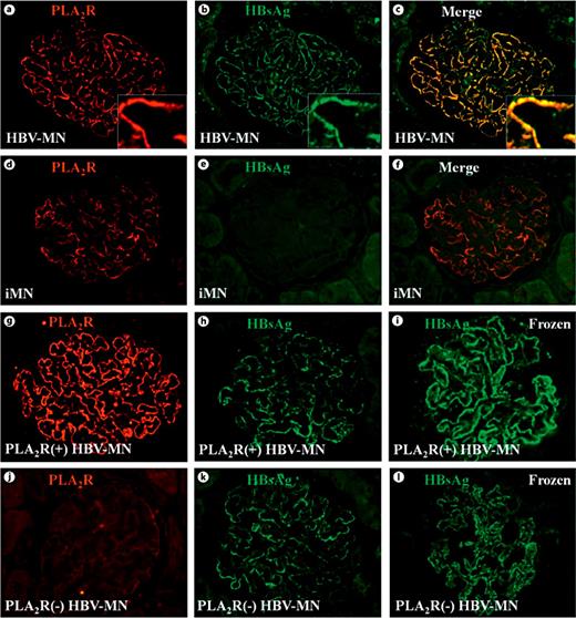 Fig. 3. PLA2R antigen was co-localized with HBsAg antigen in the PLA2R(+) HBV-MN kidneys. PLA2R was co-localized with HBsAg along the glomerular capillary loop in the HBV-MN patients with PLA2R(+) (a-c), but not in the idiopathic MN patients with PLA2R(+) (d-f). Single staining for HBsAg was positive in PLA2R(+) HBV-MN (g-i) and PLA2R(-) HBV-MN (j-l) both in paraffin-embedded and frozen tissue. (Original magnification ×400 for all above.)