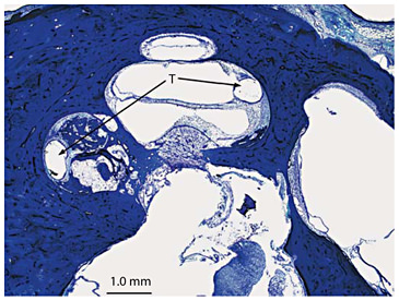 Fig. 8. Transscalar migration of the electrode in subject 12, who became profoundly deaf at age 59 years secondary to chronic otitis media. Explantation of a malfunctioning single channel device and reimplantation with a multichannel electrode was performed in this right ear. New bone was found in the inner ear for approximately 2 mm apical to the cochleostomy site. The electrode track (T) passed through the basilar membrane from one scala to another scala at 3 separate locations (toluidine blue O stain).