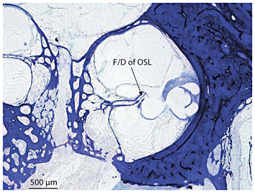 Fig. 10. Fracture/dislocation of osseous spiral lamina in the middle turn of the right ear in subject 21 who became totally deaf secondary to bilateral sudden hearing loss with vertigo at age 20 years. Fracture and dislocation (F/D) of the osseous spiral lamina (OSL) by the electrode of an Ineraid cochlear implant was seen (toluidine blue O stain).
