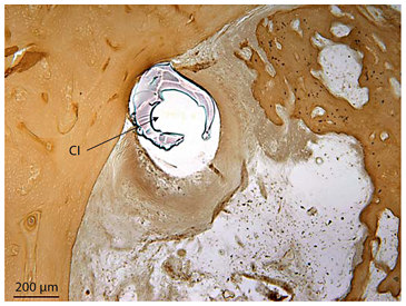Fig. 12. Dissection of spiral ligament to the bony cochlear wall in the ascending limb of the basal turn of the left ear in subject 20 who had bilateral profound hearing loss of unknown cause since childhood but in whom cochleosaccular degeneration was identified histologically. The electrode (CI) had dissected to the bony wall in the ascending basal turn, 5.5 mm from cochleostomy (unstained).