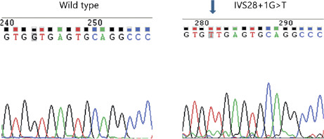 Fig. 2. DNA sequencing electropherograms of the OTOF exon 28 5′ ss region from a normal individual (wild-type, left) and AN2 (right). The G to T mutation site is indicated by the arrow. The normal G and mutant T at this location is highlighted in grey in both panels.