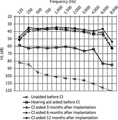 Fig. 1. Free-field pure-tone audiometry mean results in elderly patients (n = 30) before and 3, 6, and 12 months after cochlear implantation. The results present improvement with time.