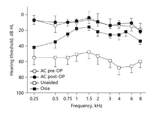 Fig. 3. Pure tone audiometry (n = 5). Mean pre- (AC pre-op, circles) and postoperative (AC post-op, black circles) air conduction thresholds of the (hearing) contralateral ear and thresholds of the deaf side unaided (unaided, white squares) and aided with the Osia (Osia, black squares) 3 months after surgery are shown ± standard deviation.