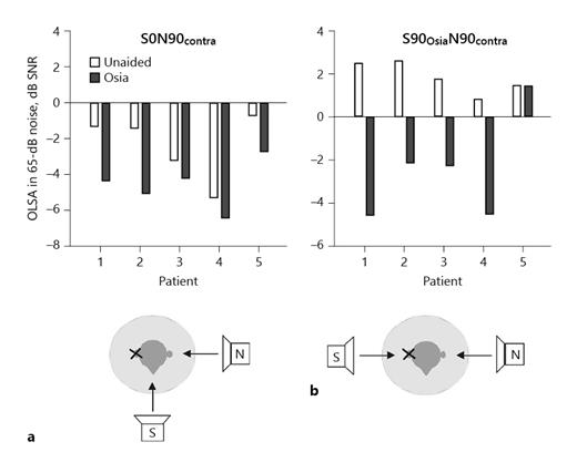 Fig. 5. Displayed are the results of the OLSA in noise (n = 5). SRT50 in 65-dB noise for n = 5 subjects unaided (white bars) and aided with the Osia (black bars) for the measurement setup S0N90contra (a) and S90OsiaN90contra (b). OLSA, Oldenburg sentence test; SRT, speech reception threshold.